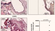 Active cigarette smoking and COPD up-regulate ACE2 expression in lower airways, which in part may explain the increased risk of severe COVID-19 in these populations. Image credit: Leung et al, doi: 10.1183/13993003.00688-2020.
