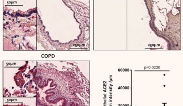 Active cigarette smoking and COPD up-regulate ACE2 expression in lower airways, which in part may explain the increased risk of severe COVID-19 in these populations. Image credit: Leung et al, doi: 10.1183/13993003.00688-2020.