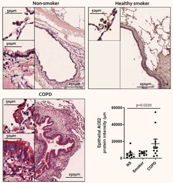 Active cigarette smoking and COPD up-regulate ACE2 expression in lower airways, which in part may explain the increased risk of severe COVID-19 in these populations. Image credit: Leung et al, doi: 10.1183/13993003.00688-2020.