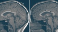 Reconstructed sagittal 5-mm orthogonal midline images in the brain using the sagittal 3D T1-weighted data set: (left) preflight baseline image and (right) matching postflight image (postflight day 1) in the same astronaut; the black arrowheads show upward expansion of the anterior, middle, and posterior superior margins of the lateral ventricle with associated narrowing of the marginal sulcus of the cingulate sulcus (white arrowhead); there is subtle expansion of the third ventricle (indicated by a 3), which has displaced the thalamus (T) from midline, making it less visible; there is thickening of the intermediate signal scalp soft tissues (arrows). Image credit: Kramer et al, doi: 10.1148/radiol.2020191413.