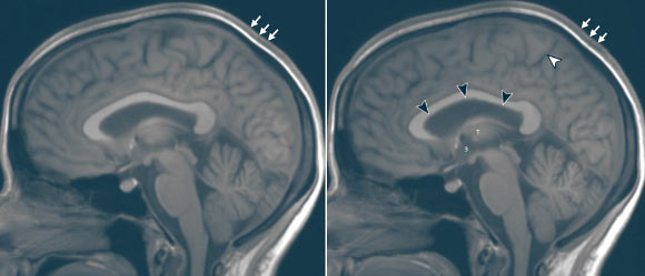 Reconstructed sagittal 5-mm orthogonal midline images in the brain using the sagittal 3D T1-weighted data set: (left) preflight baseline image and (right) matching postflight image (postflight day 1) in the same astronaut; the black arrowheads show upward expansion of the anterior, middle, and posterior superior margins of the lateral ventricle with associated narrowing of the marginal sulcus of the cingulate sulcus (white arrowhead); there is subtle expansion of the third ventricle (indicated by a 3), which has displaced the thalamus (T) from midline, making it less visible; there is thickening of the intermediate signal scalp soft tissues (arrows). Image credit: Kramer et al, doi: 10.1148/radiol.2020191413.