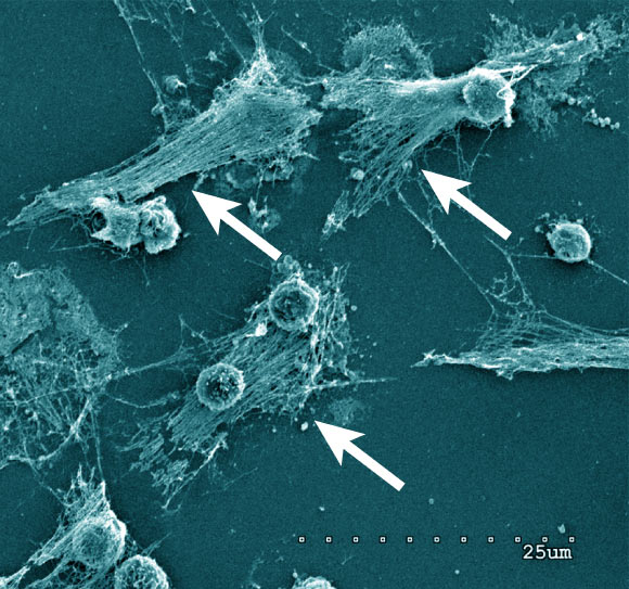 Neutrophils forming NETs in cell culture. Note the expelled DNA strings (arrows). Scanning electron microscopy of neutrophils 3 h after plating and coculturing with 4T1 breast cancer cells. Scale bar - 25 µm. Image credit: Barnes et al, doi: 10.1084/jem.20200652.