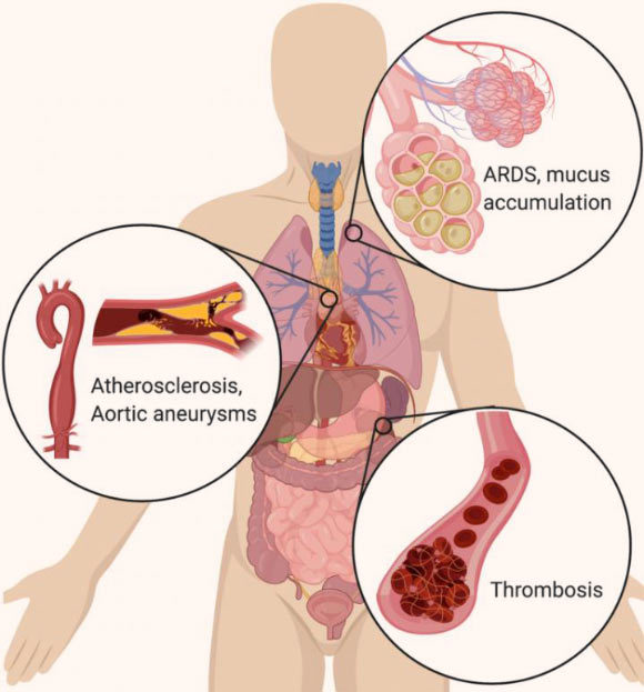 In the lungs, NETs drive the accumulation of mucus in cystic fibrosis patients’ airways. NETs also drive acute respiratory distress syndrome (ARDS) after a variety of inducers, including influenza. In the vascular system, NETs drive atherosclerosis and aortic aneurysms, as well as thrombosis (particularly microthrombosis), with devastating effects on organ function. Image credit: Cold Spring Harbor Laboratory.