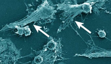 Neutrophils forming NETs in cell culture. Note the expelled DNA strings (arrows). Scanning electron microscopy of neutrophils 3 h after plating and coculturing with 4T1 breast cancer cells. Scale bar - 25 µm. Image credit: Barnes et al, doi: 10.1084/jem.20200652.