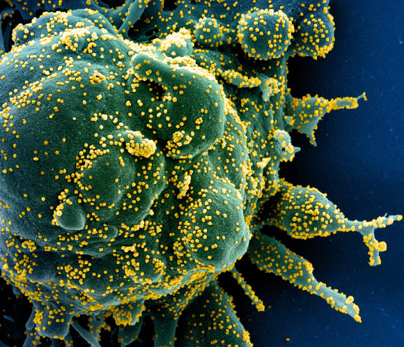 Colorized scanning electron micrograph of an apoptotic cell (green) heavily infected with SARS-COV-2 virus particles (yellow), isolated from a patient sample. Image credit: NIAID.