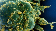 Colorized scanning electron micrograph of an apoptotic cell (green) heavily infected with SARS-COV-2 virus particles (yellow), isolated from a patient sample. Image credit: NIAID.