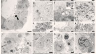 Transmission electron microscopy analysis of SARS-CoV-2 infected intestinal organoids: (a to h) overview of an intact organoid (a) showing the onset of virus infection (b to d) at different stages of the viral lifecycle, i.e., early double membrane vesicles (DMVs); (e), asterisk, initial viral production in the Golgi apparatus (f and g) and complete occupation of virus particles inside the endomembrane system (h); (i to k) extracellular viruses are observed in the lumen of the organoid (i), and are found at the basal (j) and apical side (k) alongside the microvilli (arrows). Scale bars - 10 μm (a), 2.5 μm (b to d), 250 nm (e), (f), and (h to k) and 100 nm (g). (l to q) Overview of an organoid (l) showing severely infected cells (m and o), disintegrated cells (o) and stressed cells as evident from the atypical nucleoli (p); intact cells reveal DMV areas of viral replication (p), asterisks, and infected Golgi apparatus (q); (r) extracellular clusters of viruses. Scale bars - 10 μm (l), 2.5 μm (m to p) and 250 nm (p to r). Image credit: Lamers et al, doi: 10.1126/science.abc1669.