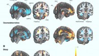 Differences in brain activity between connected and disconnected states of consciousness studied with positron emission tomography imaging. Activity of the thalamus, anterior (ACC) and posterior cingulate cortices (PCC), and bilateral angular gyri (AG) show the most consistent associations with the state of consciousness (A = general anesthesia, B = sleep). The same brain structures, which are deactivated when the state of consciousness changes to disconnected in general anesthesia or natural sleep (cool colors in the left columns), are reactivated when regaining a connected state upon emergence from anesthesia (warm colors in the right columns). Image credit: Scheinin et al., doi: 10.1523/JNEUROSCI.0775-20.2020.