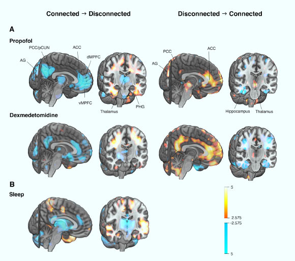 Differences in brain activity between connected and disconnected states of consciousness studied with positron emission tomography imaging. Activity of the thalamus, anterior (ACC) and posterior cingulate cortices (PCC), and bilateral angular gyri (AG) show the most consistent associations with the state of consciousness (A = general anesthesia, B = sleep). The same brain structures, which are deactivated when the state of consciousness changes to disconnected in general anesthesia or natural sleep (cool colors in the left columns), are reactivated when regaining a connected state upon emergence from anesthesia (warm colors in the right columns). Image credit: Scheinin et al., doi: 10.1523/JNEUROSCI.0775-20.2020.