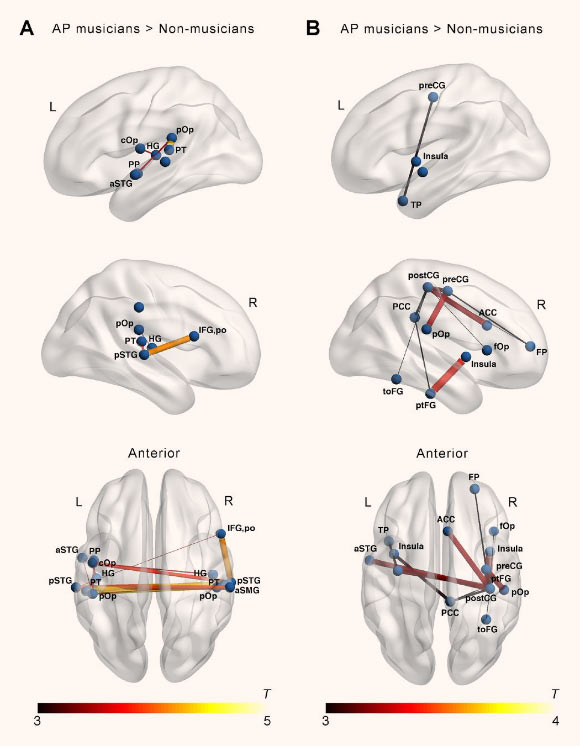 Increased subnetworks in absolute pitch musicians compared to non-musicians obtained in the whole-brain network-based statistic (NBS) analysis for resting-state functional connectivity (A) and diffusion weighted imaging (DWI)-based structural connectivity (B). Abbreviations: ACC - anterior cingulate cortex; AP - absolute pitch; aSMG - anterior supramarginal gyrus; aSTG - anterior superior temporal gyrus; cOp - central operculum; fOp - frontal operculum; FP - frontal pole; HG - Heschl’s gyrus; IFG, po - inferior frontal gyrus, pars opercularis; L - left; MTG - middle temporal gyrus; PCC - posterior cingulate cortex; postCG - postcentral gyrus; preCG - precentral gyrus; pSTG - superior temporal gyrus, posterior division; pOp - parietal operculum; PP - planum polare; PT - planum temporale; ptFG - posterior temporal fusiform gyrus; R - right; toFG - temporal occipital fusiform gyrus; TP - temporal pole. Image credit: Leipold et al., doi: 10.1523/JNEUROSCI.1985-20.2020.