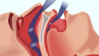 Obstructive sleep apnea is a condition where the airway closes off during sleep and so the lungs cannot oxygenate the blood adequately. Image credit: Habib M’henni.