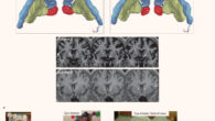 Characterization of human accumbens electrophysiological signal provoked by exposure to preferred food stimuli: (a) schematic of the multi-stage, staggered enrollment, early feasibility study design; the current stage of each participant within the trial is highlighted (blue - subject 1; green - subject 2); (b) two quadripolar depth electrodes placed bilaterally in the nucleus accumbens; (c) the multi-item buffet of preferred foods allowing us to examine nucleus accumbens electrophysiology during LOC eating as well as the preceding in-lab standardized meals. Image credit: Shivacharan et al., doi: 10.1038/s41591-022-01941-w.