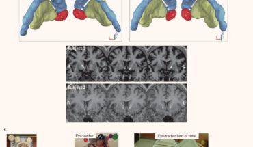 Characterization of human accumbens electrophysiological signal provoked by exposure to preferred food stimuli: (a) schematic of the multi-stage, staggered enrollment, early feasibility study design; the current stage of each participant within the trial is highlighted (blue - subject 1; green - subject 2); (b) two quadripolar depth electrodes placed bilaterally in the nucleus accumbens; (c) the multi-item buffet of preferred foods allowing us to examine nucleus accumbens electrophysiology during LOC eating as well as the preceding in-lab standardized meals. Image credit: Shivacharan et al., doi: 10.1038/s41591-022-01941-w.
