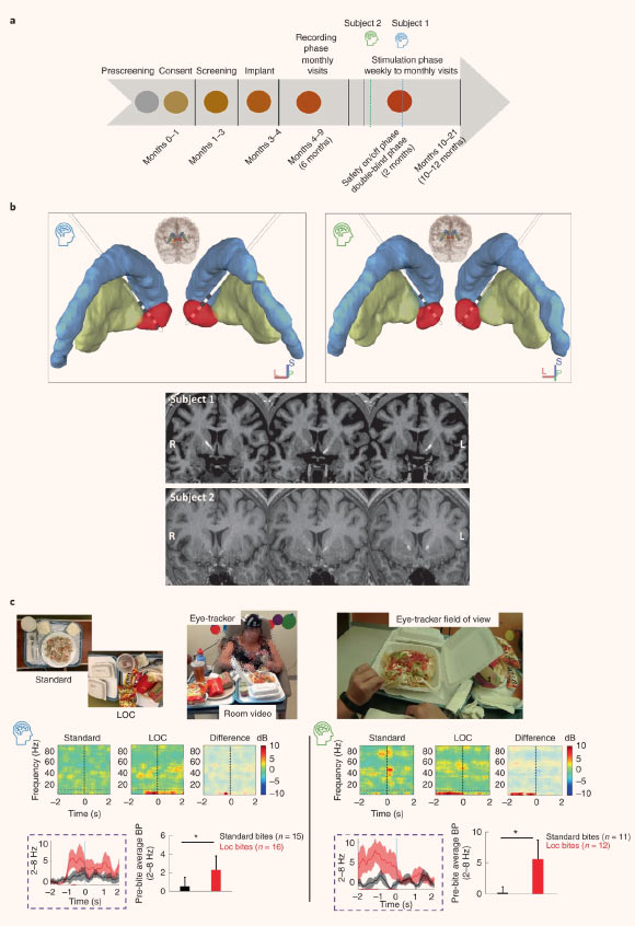 Characterization of human accumbens electrophysiological signal provoked by exposure to preferred food stimuli: (a) schematic of the multi-stage, staggered enrollment, early feasibility study design; the current stage of each participant within the trial is highlighted (blue - subject 1; green - subject 2); (b) two quadripolar depth electrodes placed bilaterally in the nucleus accumbens; (c) the multi-item buffet of preferred foods allowing us to examine nucleus accumbens electrophysiology during LOC eating as well as the preceding in-lab standardized meals. Image credit: Shivacharan et al., doi: 10.1038/s41591-022-01941-w.