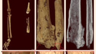 Surgically amputated site of the left tibia and fibula of the Liang Tebo individual: (a) left and right legs with pelvic girdle, demonstrating the complete absence of the distal third of the left lower leg; (b) left tibia and fibula showing the amputation surface, atrophy and necrosis; the bone surface is more porous because lysis occurred to remove the dead bone (necrosis); (c) radiograph of the left tibia and fibula; (d) left tibia medial aspect; (e) left tibia medial aspect; (f) left fibula anterior aspect. Scale bars - 5 cm in (a), 5 mm in (b and c) and 2 mm in (d-f). Image credit: Maloney et al., doi: 10.1038/s41586-022-05160-8.
