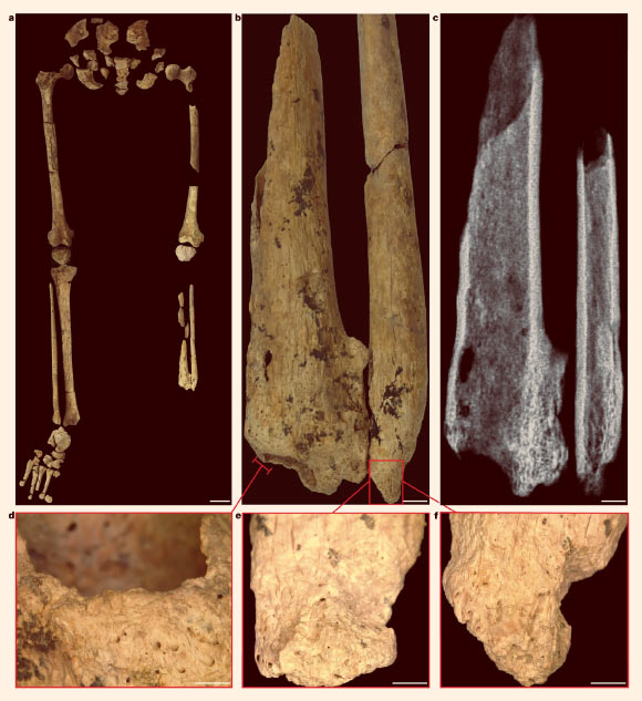 Surgically amputated site of the left tibia and fibula of the Liang Tebo individual: (a) left and right legs with pelvic girdle, demonstrating the complete absence of the distal third of the left lower leg; (b) left tibia and fibula showing the amputation surface, atrophy and necrosis; the bone surface is more porous because lysis occurred to remove the dead bone (necrosis); (c) radiograph of the left tibia and fibula; (d) left tibia medial aspect; (e) left tibia medial aspect; (f) left fibula anterior aspect. Scale bars - 5 cm in (a), 5 mm in (b and c) and 2 mm in (d-f). Image credit: Maloney et al., doi: 10.1038/s41586-022-05160-8.