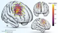 Network modeling of fluid intelligence. Image credit: Cipolotti et al., doi: 10.1093/brain/awac304.