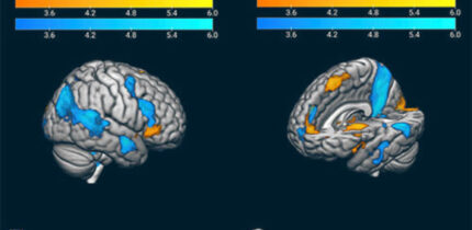 Mendieta et al. used fMRI to measure brain activity in fans of rival soccer teams during match play. This image shows the contrast of winning and losing in the ‘good fanatic brain.’ It shows in warm colors the activity related to a significant victory. The blue scale represents the activation related to a significant loss; this pattern is congruent with the Mentalization Network, which suggests a rationalization process of the pain evoked by the losing scenario. Image credit: Mendieta et al.