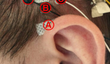 Positions of electrodes used to cover the superior auricular muscles. Image credit: Schroeer et al., doi: 10.3389/fnins.2024.1462507.